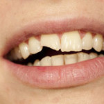 A woman with a chipped front tooth